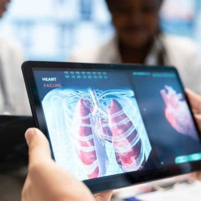 Nódulo pulmonar: o que é e quando deve ser avaliado